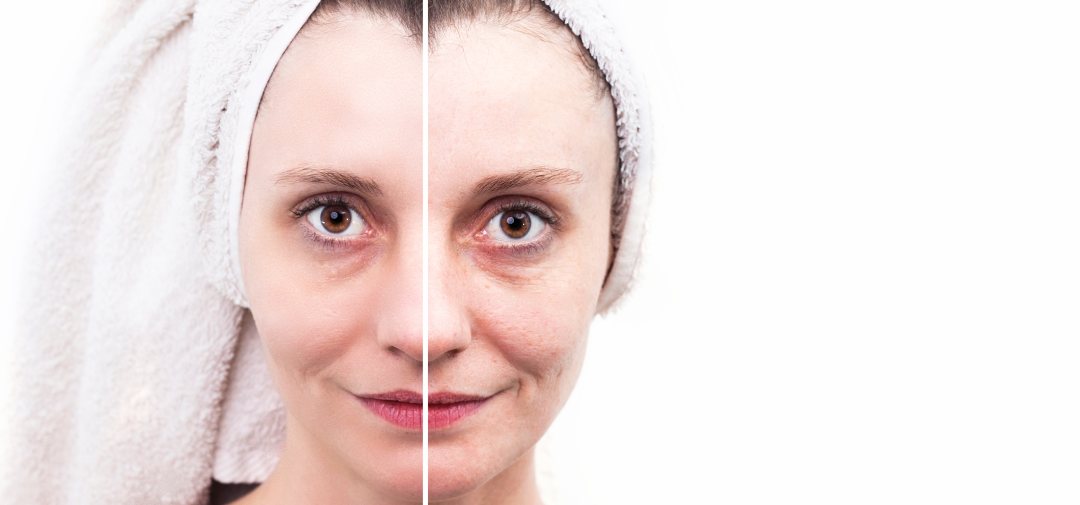 A before-and-after image highlighting deep pore cleansing benefits of Skinwave.