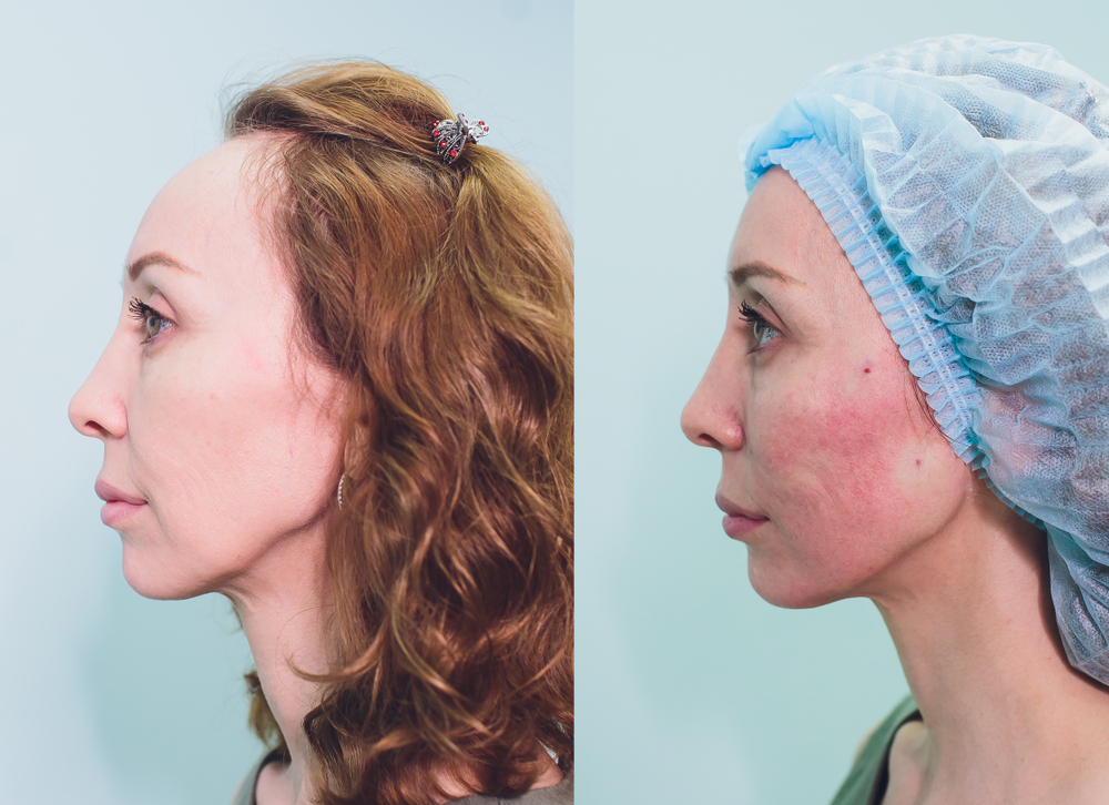 Before and after images of a woman showcasing noticeable improvements with PDO threads.