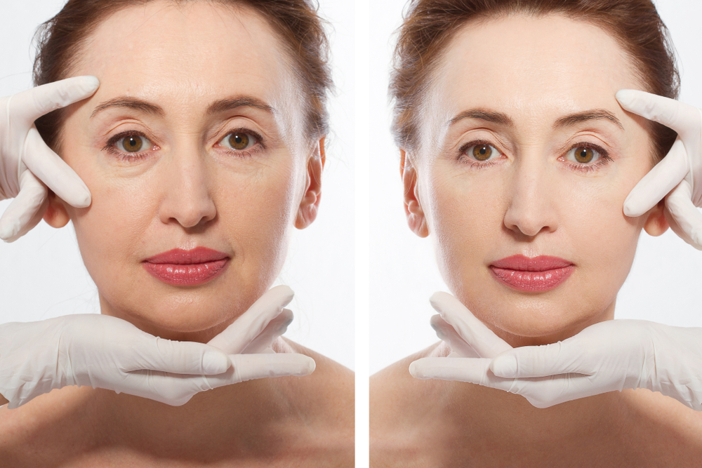 A before-and-after comparison showing visible improvements in facial volume and smoothness after dermal fillers treatment.