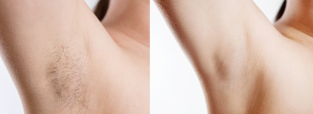 Before and after results of laser hair removal showing smooth, hair-free underarms