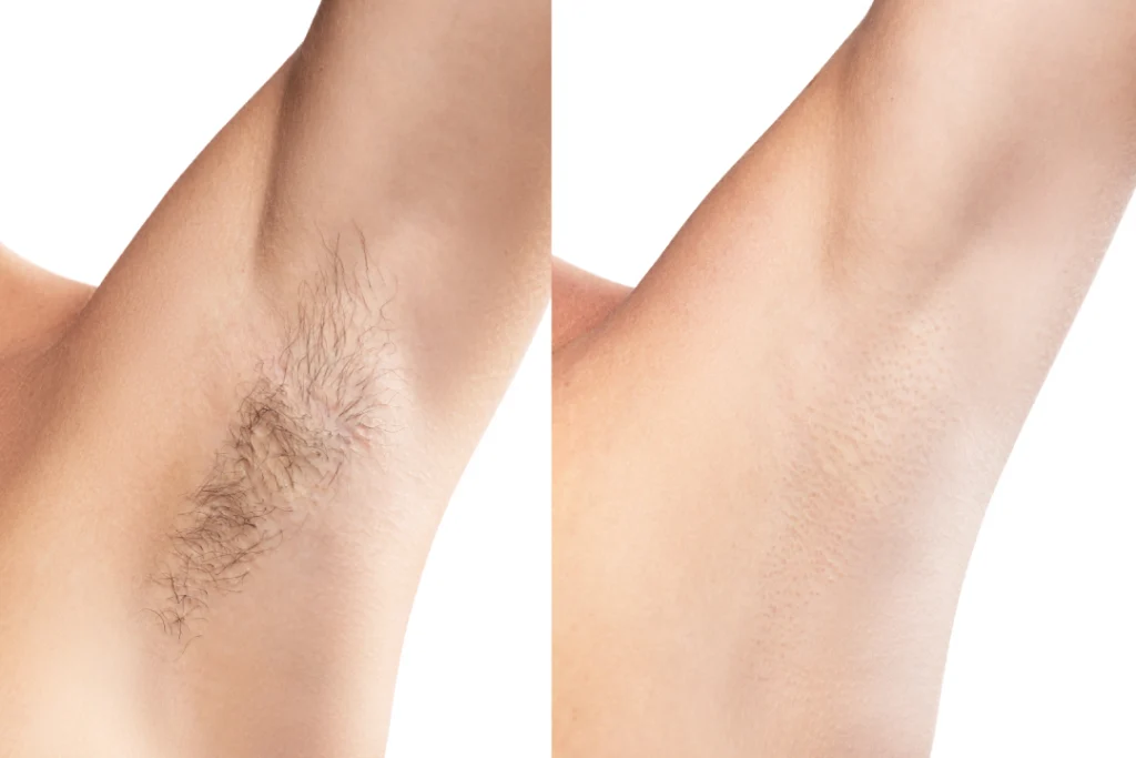 A before-and-after comparison of laser hair removal on an armpit, showing significant hair reduction.