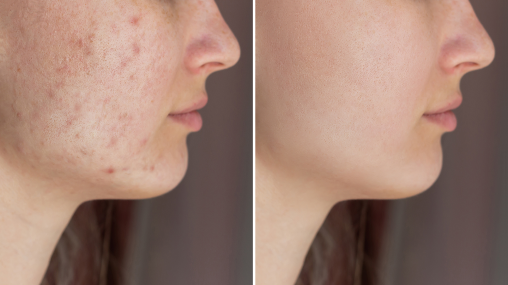 Before and after image of facial treatment showing acne improvement, highlighting clearer skin after facial skincare procedure.
