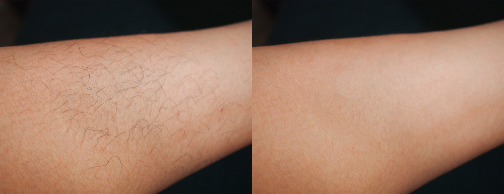 Laser hair removal before and after comparison on arm skin.