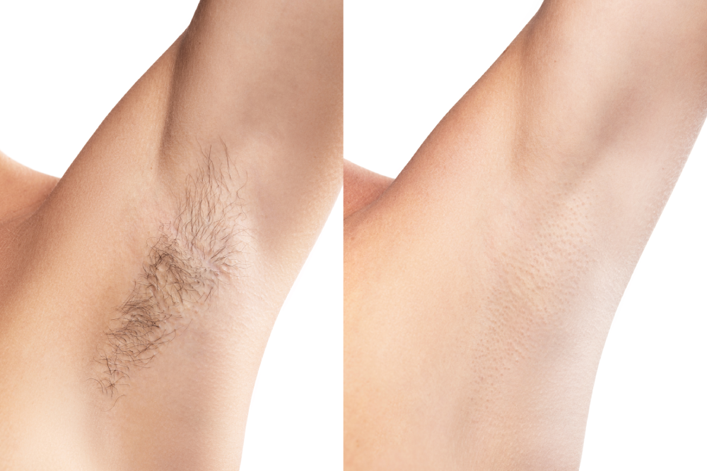 Before and after photo of underarm laser hair removal.