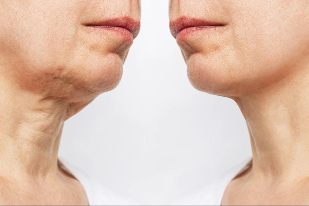 Before and after comparison of a woman's jawline treated with dermal fillers.